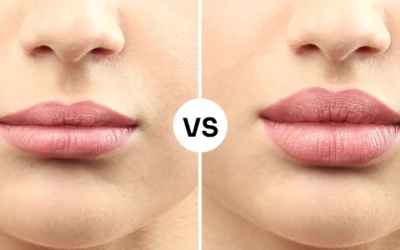 How Much Does a Natural Lip Flip Cost? Simple Guide