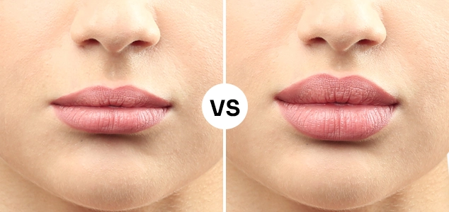 How Much Does a Natural Lip Flip Cost? Simple Guide