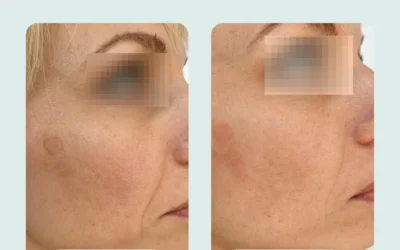 NAD+ Injections Before and After: What Results Can You Expect?