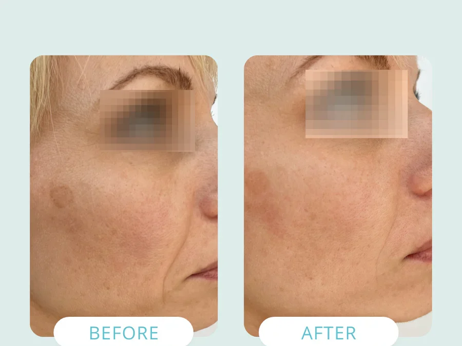 NAD+ Injections Before and After: What Results Can You Expect?